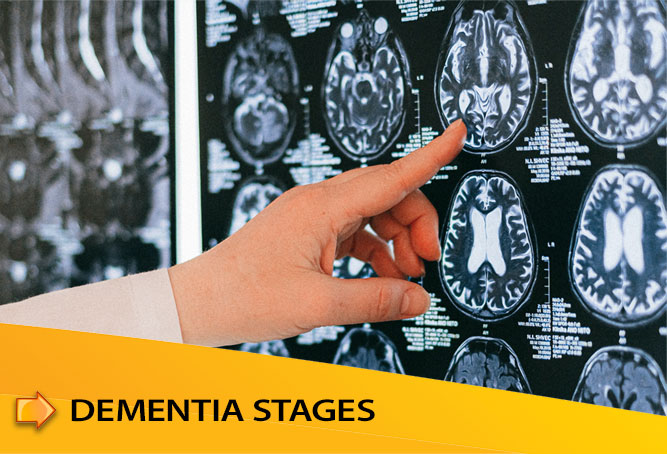 Dementia Stages